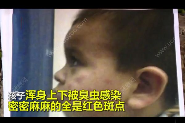 幼兒遭臭蟲咬傷獲賠1000萬(wàn)！遭到蟲子咬怎么急救？(4)