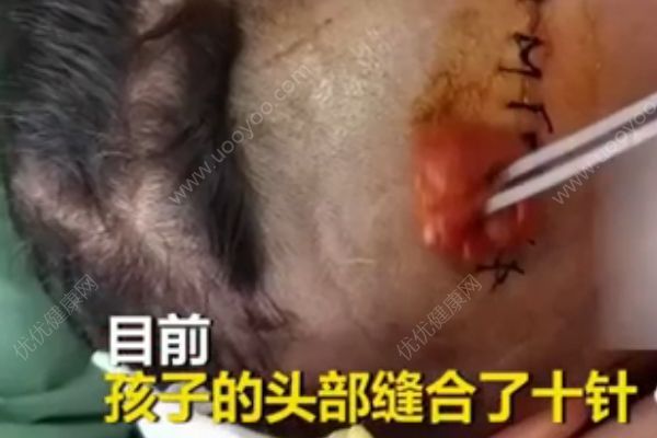 3歲男孩小區(qū)內(nèi)被狗咬頭縫10針，被狗咬傷后怎么處理？(4)