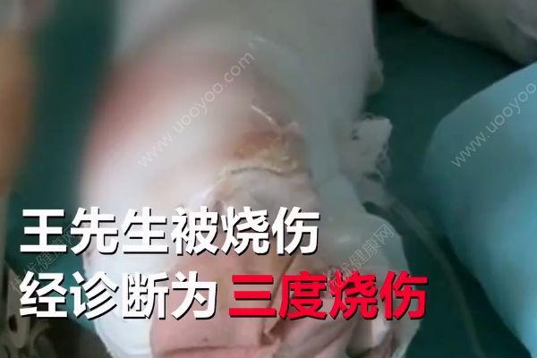 不慎引燃酒精桶，男子家中吃燒烤吃成三度燒傷(1)