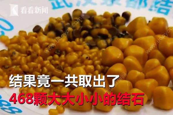 愛吃油炸長468顆結石，油炸食品的危害有哪些？(1)