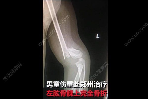 男童被踹下滑梯胳膊折成三截，肇事方家長抱娃就溜(2)