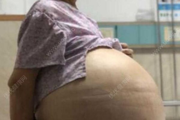 69歲大媽患婦科腫瘤肚鼓如球，醫(yī)生抽出30多升囊液(1)