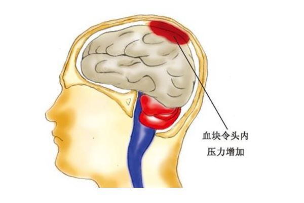 腦溢血患者家屬質(zhì)疑被過期藥加重病情，醫(yī)院:只用了一瓶(4)