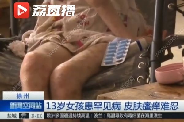 女孩患罕見病最怕熱，家貧買不起空調只靠奶奶背起來回走(3)