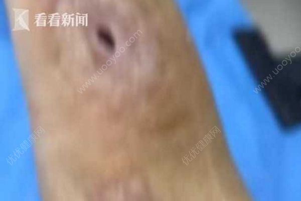 男子殺魚時不小心劃傷手指，幾個月后右手手臂被