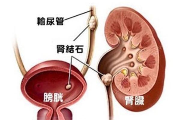 常州一大媽右腎里取出一盆結(jié)石，醫(yī)生一數(shù)，竟有2980顆(2)