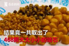 愛吃油炸長468顆結石，油炸食品的危害有哪些？[多圖]