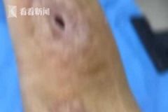 男子殺魚時不小心劃傷手指，幾個月后右手手臂被"蛀空"[多圖]