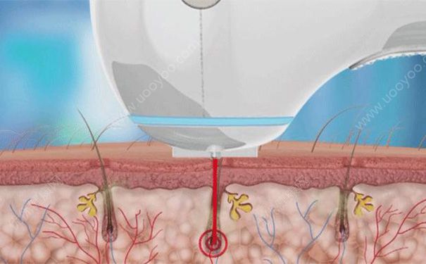 激光脫毛有副作用么？激光脫毛有什么副作用？(2)
