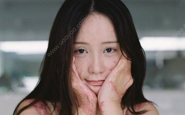 毀容少女曬寫真 毀容后如何樂觀生活？(2)