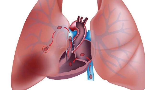 肺栓塞的癥狀有哪些？肺栓塞的臨床表現(xiàn)是什么？(1)
