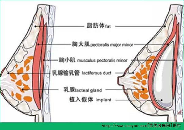 隆胸手術后可以母乳喂養(yǎng)嗎？隆胸后可以喂奶哺乳嗎？(2)