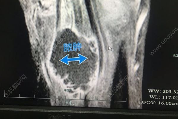 男子被蝦刺中手臂爛得差點(diǎn)截肢，被蝦刺到怎么辦(1)