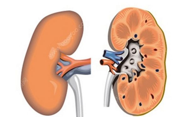 腎囊腫是怎么回事？腎囊腫治療方法(1)