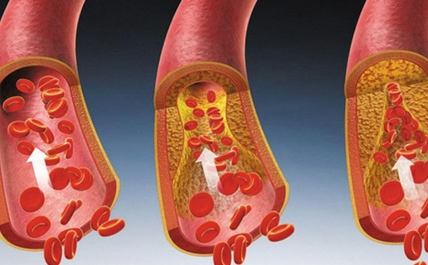 哪些食物能有效的清除血管垃圾？血管出現(xiàn)問題的癥狀有哪些？(1)