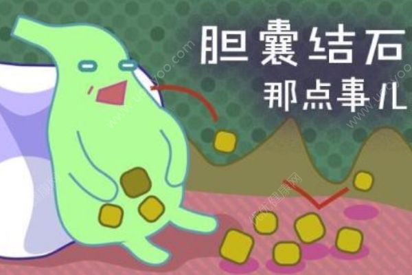 哪些人最容易得膽結(jié)石？膽結(jié)石有哪些明顯特征？(1)