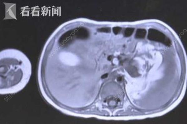 3歲女童腹腔長(zhǎng)直徑約15厘米腫瘤，嬰幼兒腫瘤如何早發(fā)現(xiàn)？(2)