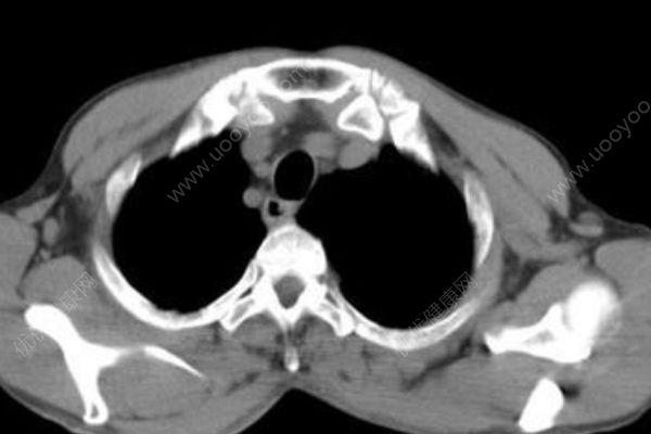 30歲小伙沒(méi)力氣上二樓，塵肺病肺已經(jīng)千瘡百孔(4)