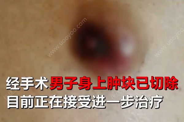 六旬老翁患上女人病！醫(yī)生說乳腺癌非女性專利！(4)