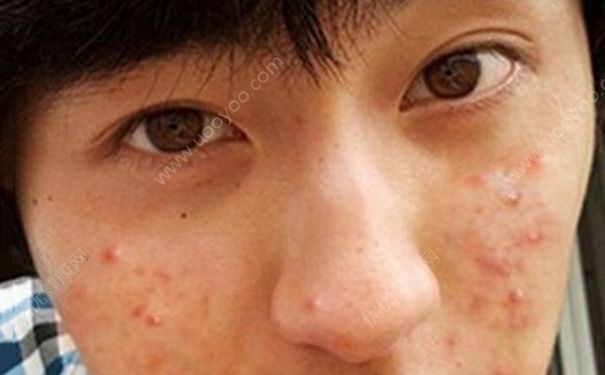 15歲男孩額頭長痘咋辦？15歲男孩臉上長痘怎么辦？(2)