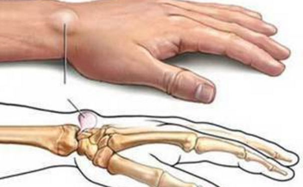 手腕起了一個鼓包怎么回事？手腕鼓包是什么原因？(1)