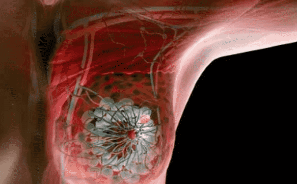 乳腺癌的早期信號是什么？誘發(fā)乳腺疾病的原因是什么？(1)