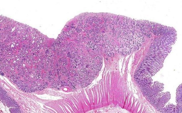 直腸癌有哪些病因？直腸癌有何治療方法？(3)