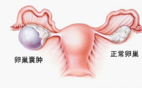 卵巢腫瘤嚴(yán)重嗎？卵巢腫瘤手術(shù)(1)