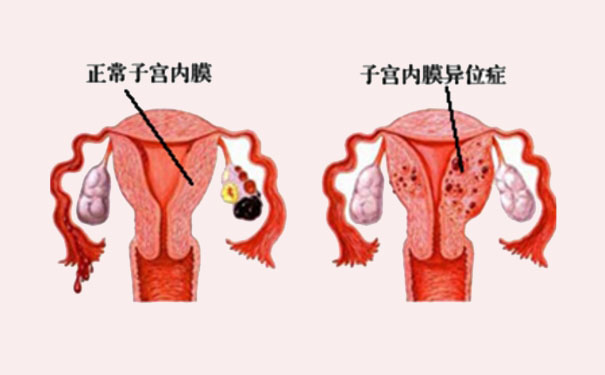 子宮內(nèi)膜異位癥能自然懷孕嗎？子宮內(nèi)膜異位癥為什么影響懷孕？(1)