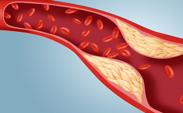 動脈粥樣硬化有哪些危害？動脈粥樣硬化怎么調(diào)理？(1)