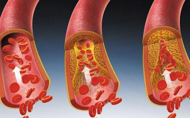 如何清除血管內(nèi)垃圾？血管有垃圾有何危害？(1)