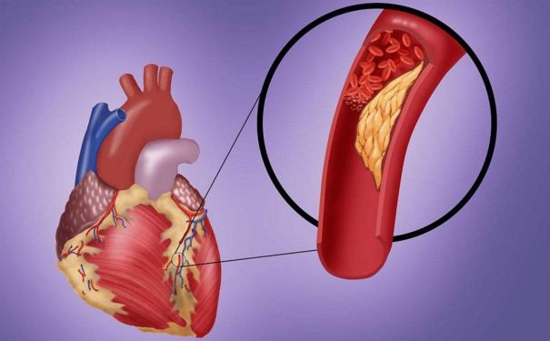 動脈硬化有何癥狀？動脈硬化如何診斷？(1)