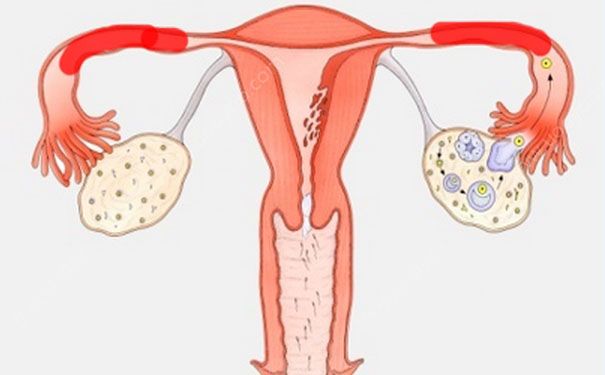 輸卵管堵塞還能排卵嗎？輸卵管堵塞怎么辦？(2)