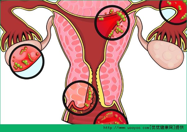 婦科病有哪些？常見的婦科病有哪些？(3)