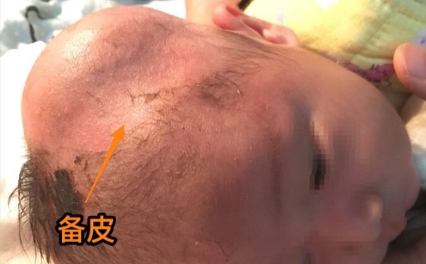 嬰兒腦血腫有后遺癥嗎？嬰兒腦血腫該怎么辦？(1)