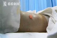 女子清晨上廁所踩到毒蛇被咬，整條腿變"大象腿"[多圖]