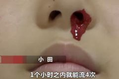 一學(xué)習(xí)就流鼻血！12歲男孩一天流20多次無奈休學(xué)！[多圖]