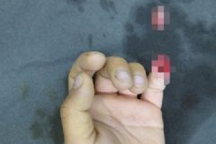 6歲男孩被夾斷手指，罪魁禍?zhǔn)拙故切７种笖嗔巳绾渭本?？[多圖]