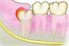 智齒發(fā)炎應(yīng)該怎么辦？智齒很疼該不該拔掉？[多圖]