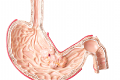 哪些習慣容易患胃癌？哪些人容易患胃癌？[圖]