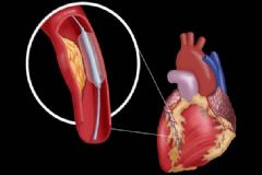 心臟病人要如何護(hù)理？心臟病有哪些危害？[圖]