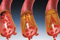 如何清除血管內(nèi)垃圾？血管有垃圾有何危害？[圖]