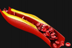 如何預防血管堵塞？怎么樣預防血管堵塞？[圖]