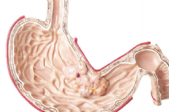 胃癌早期的癥狀有哪些？如何及時發(fā)現(xiàn)胃癌征兆？[圖]
