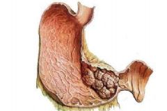 胃癌早期能治好嗎？胃癌早期有那些癥狀？[圖]
