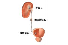 膀胱結(jié)石手術(shù)治療會有效嗎？膀胱結(jié)石手術(shù)治療的效果[圖]