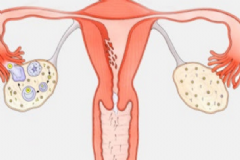 卵巢切除后怎么保養(yǎng)好？卵巢切除后怎么保養(yǎng)？[圖]
