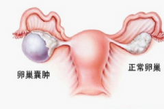 卵巢腫瘤嚴(yán)重嗎？卵巢腫瘤手術(shù)[圖]