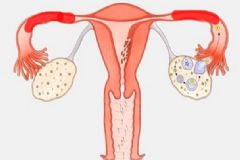 輸卵管堵塞還能排卵嗎？輸卵管堵塞怎么辦？[多圖]