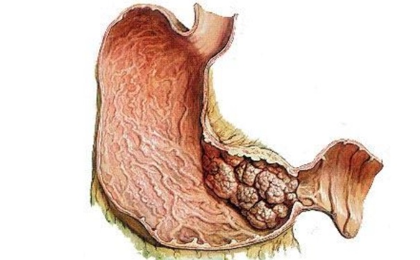 胃癌早期能治好嗎？胃癌早期有那些癥狀？(1)
